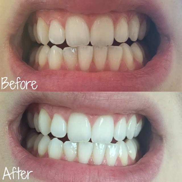 Cocowhite, Oil Pulling, White Teeth, Teeth Whitening, Before and after