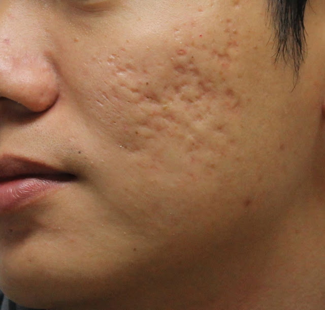 Acne scars 