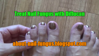 Treat Nail Fungus with Diflucan