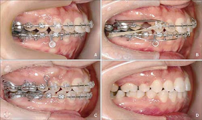 Các loại hình niềng răng mọc lệch lạc-2
