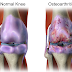 WHAT IS OSTEOARTHRITIS OF THE KNEES