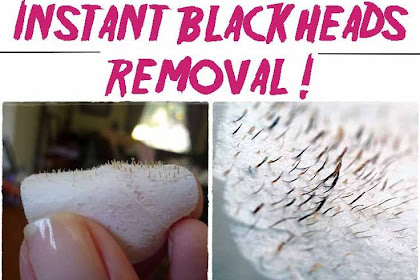 Remove The Blackheads On Your Nose With This Simple Remedy