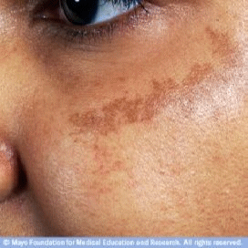 CaRing n bEautY bLogSpot.cOm: What is Hyperpigmentation?
