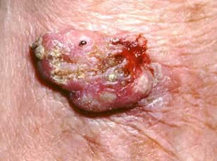 skin cancer squamous cell