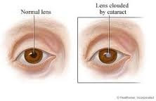Cataract Factors Causes, Symptoms and Treatment