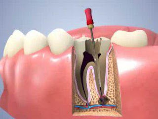 Quy trình lấy tuỷ răng được thực hiện như thế nào ?