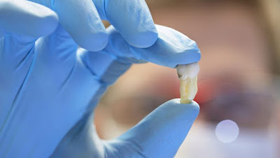 Niềng răng không nhổ răng có lợi ích gì