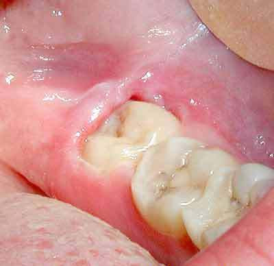 Nhiễm khuẩn răng miệng là bệnh gì? 