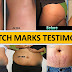 SKIN PROBLEMS AND STRETCH MARKS TESTIMONIES 