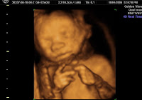 3d Ultrasound Pregnancy6