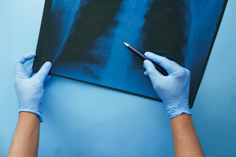 How is a diagnosis of mesothelioma confirmed