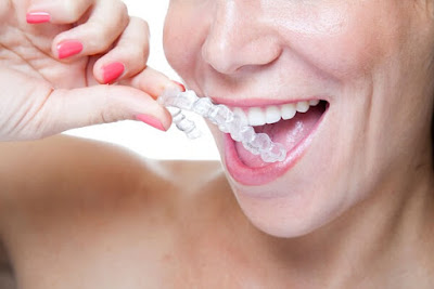 Quá trình niềng răng invisalign có đau không?-2