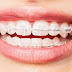 Niềng răng có những lợi ích như thế nào?