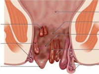 Cara Ampuh Hilangkan Benjolan Ambeien