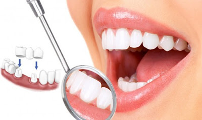 Nên trồng răng giả loại nào tốt và bền đẹp bằng công nghệ mới?