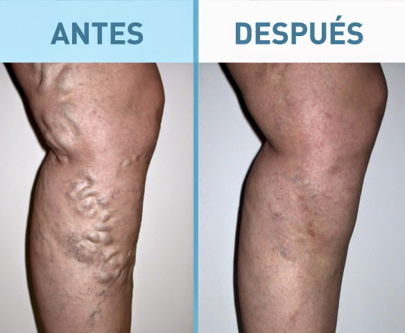 solucion para las varices