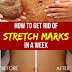 How To Get Rid Of Stretch Marks In A Week