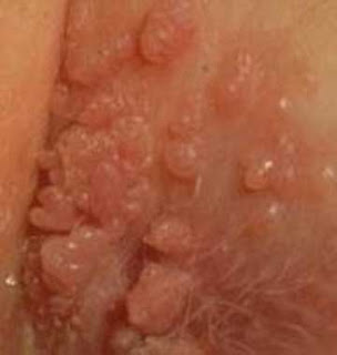 Gejala Human Papilloma Virus (Hpv)
