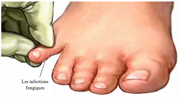 Dites adieu aux infections fongiques: tremper les pieds dans ...