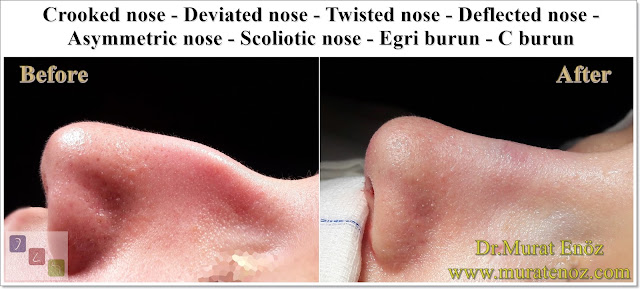 C Burun - Crooked Nose - Deviated Nose - Twisted Nose - Deflected Nose - Asymmetric Nose - Scoliotic Nose - Rhinoplasty in Istanbul - Rhinoplasty Istanbul - Rhinoplasty in Turkey - Rhinoplasty Turkey - Nose Job Istanbul - Nose Job Turkey