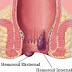 Terasa mengganjal di sekitar anus dan sulit BAB
