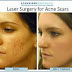 Can Acne Scar Treatment Really Help?