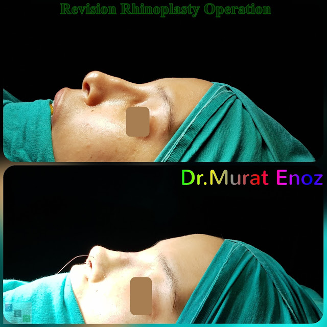 revision rhinoplasty in istanbul