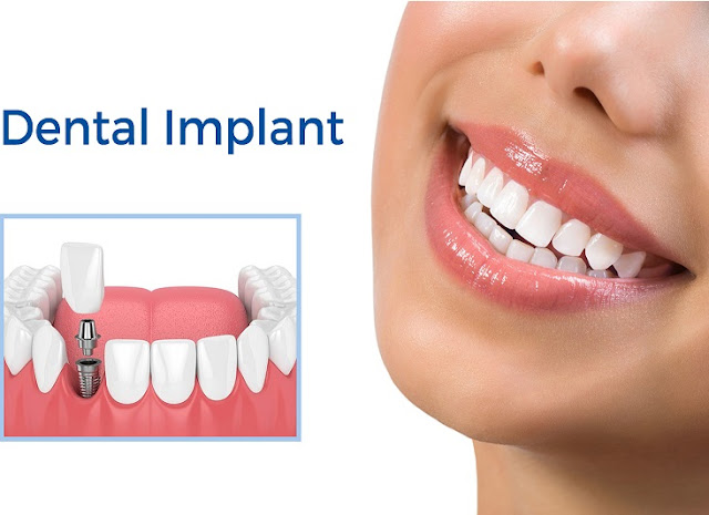 Dental Implant clinic Near me