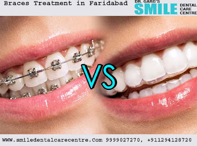 Best Braces Treatment Orthodontist Dental Clinic in Faridabad