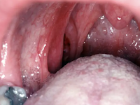  Oral Cancer Symptoms, Causes, and Prevention