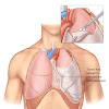 Pleurectomy Decortication is Effective Treatment for Mesothelioma Cancer
