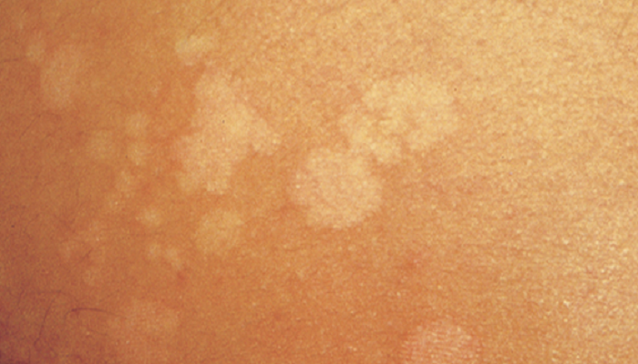 kleienpilzflechte hausmittel (Pityriasis versicolor ...