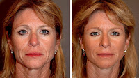 How Much Does A Neck Lift Cost