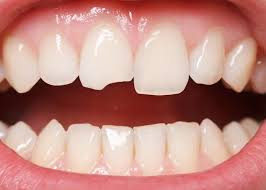 Cách chăm sóc răng sứ sau khi phục hồi thế nào?