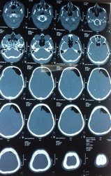 Chronic sub dural hematoma ct scan