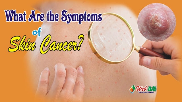 What Are the Symptoms of Skin Cancer?