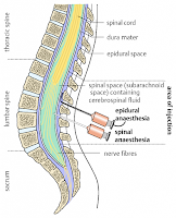 脊髓麻醉 Spinal anesthesia, SA
