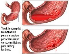 Cara menyembuhkan lambung yang luka