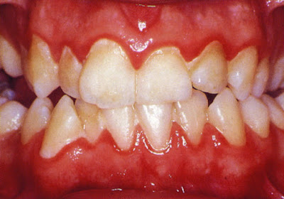 Nguyên nhân bị viêm chân răng bạn cần đề phòng-1