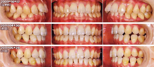 歯列矯正：定期検診その10