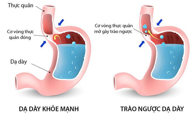 Trào ngược axit dạ dày