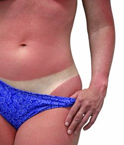 Home Remedies for Sunburn