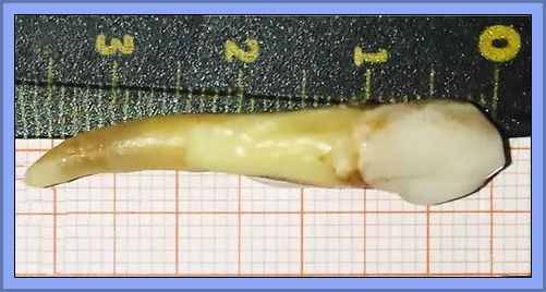 Mijo Vodopija's Record Breaking Tooth