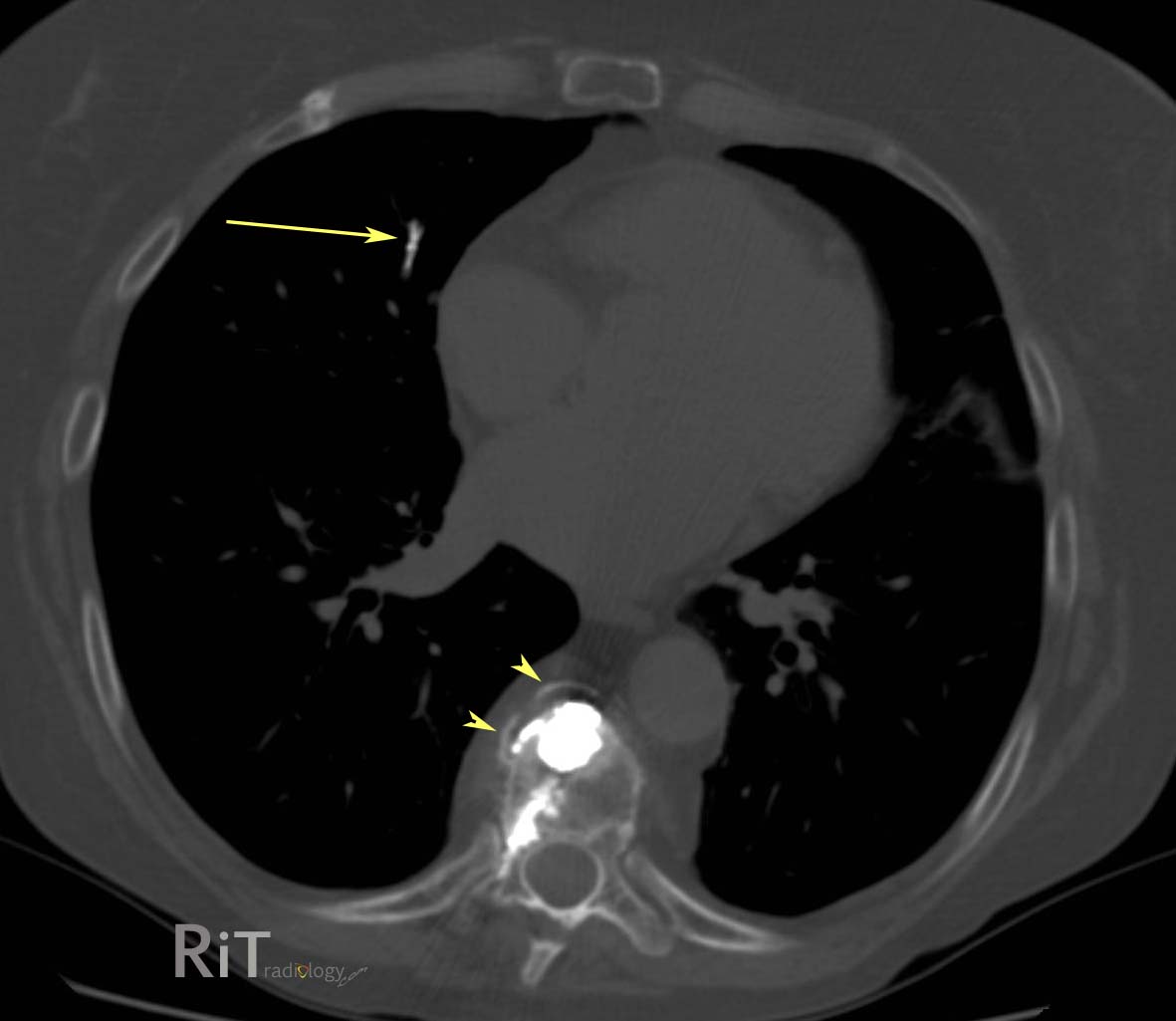 Pulmonary Embolism CT