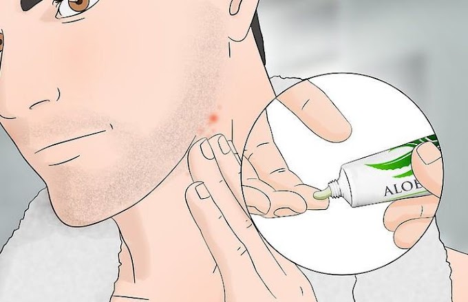 Naturally & Quick Ways to Treat Razor Burn ? 