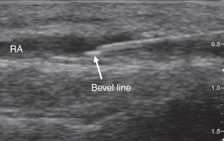 Ultrasound Artifacts