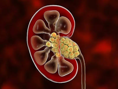 How kidney stones form?