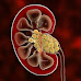 How does kidney stones form?