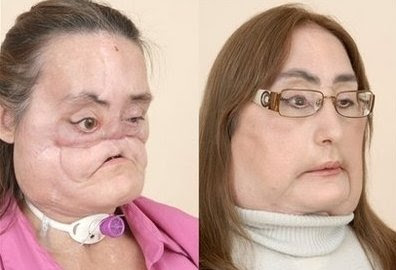 Connie Culp First Face Transplant Patient in the U.S. (Photos)