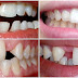 Ảnh hưởng của răng mọc lệch lạc